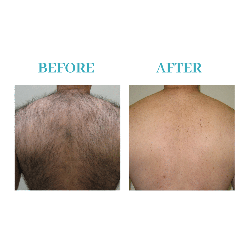 Laser Hair Removal - Beauty & Aesthetics | Salon Pierre Urmston